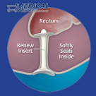 Renew Anal Insert Large 30 inserts